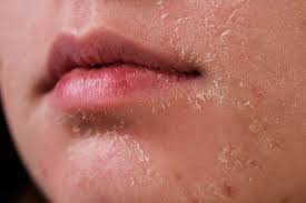 cause of dry skin