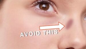 glasses mark on your nose